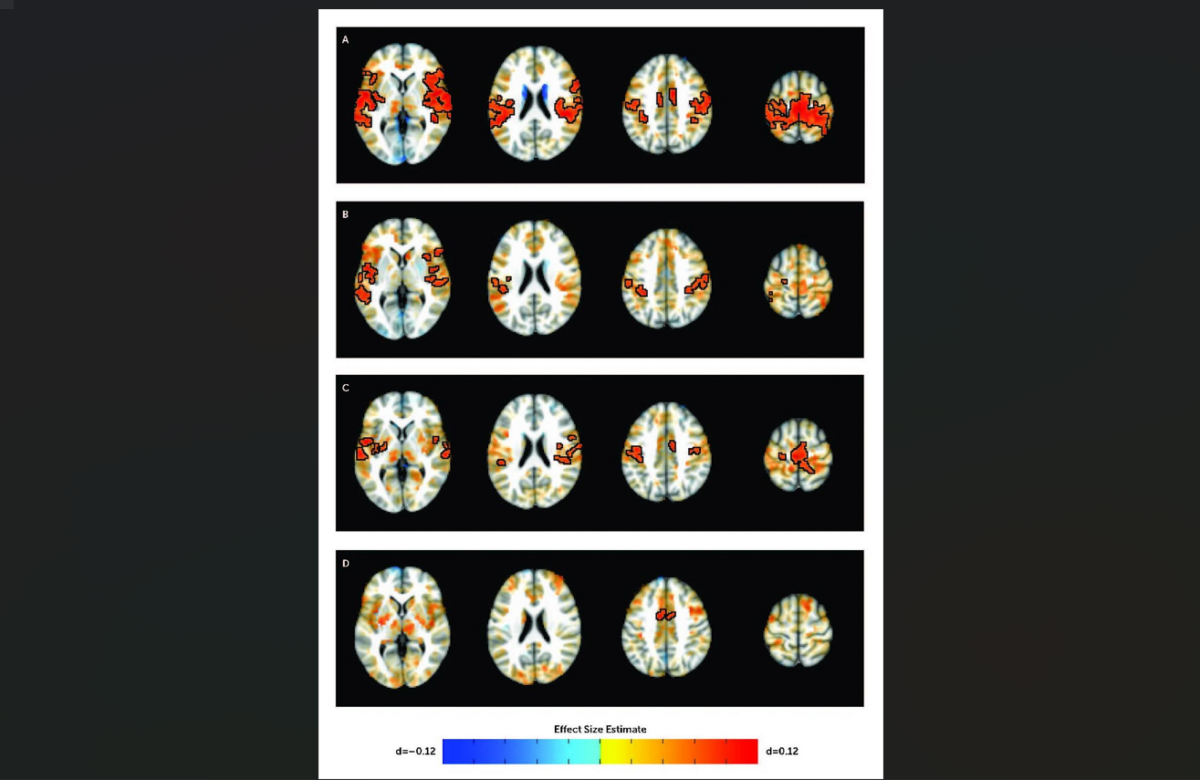 This image of brain scans shows differences in subcortico-cortical connectivity in youth with and without ADHD. Norman LJ et al, American Journal of Psychiatry
