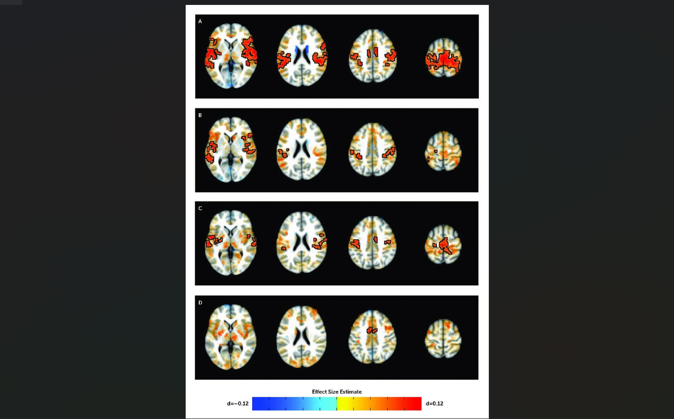 Researchers Identify Brain Connections Associated With ADHD in Youth