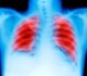 State of Lung Cancer: New Report Reveals Texas Near Bottom of Rankings for Early-Stage Diagnosis